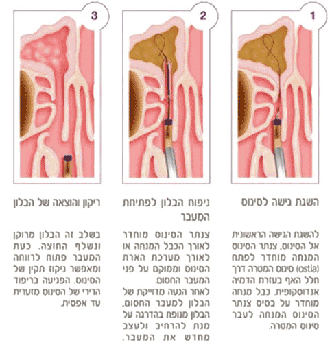 טיפול בסינוסיטיס עם טכנולוגיית ™Balloon Sinuplast